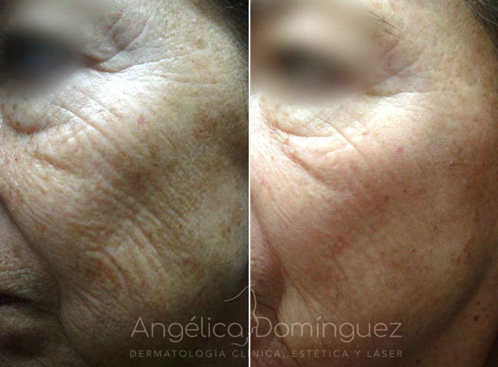 Rejuvenecimiento Facial Antes Y Despu s Antes Y Despu s Rejuvenecimiento Facial Antes Y Despu s Antes Y Despu s